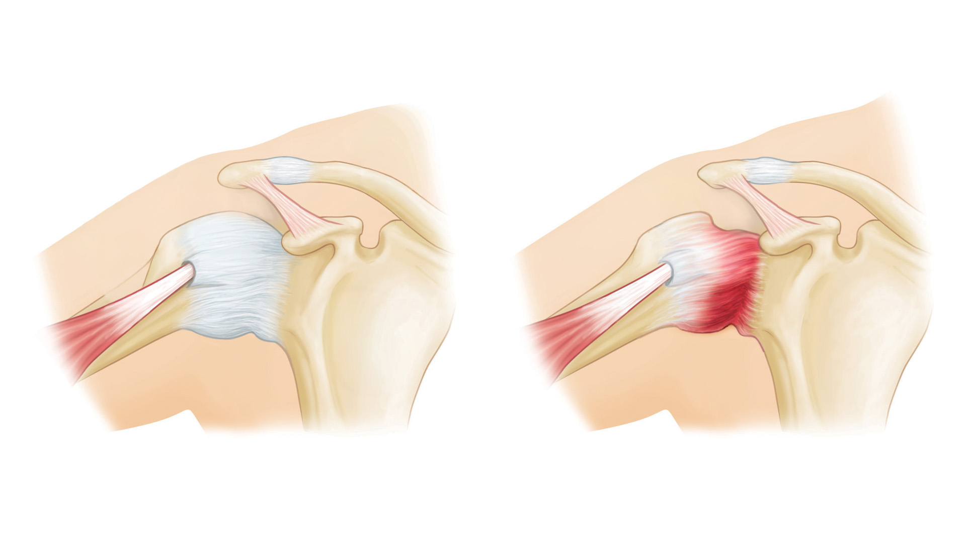 capsulite adesiva spalla congelata